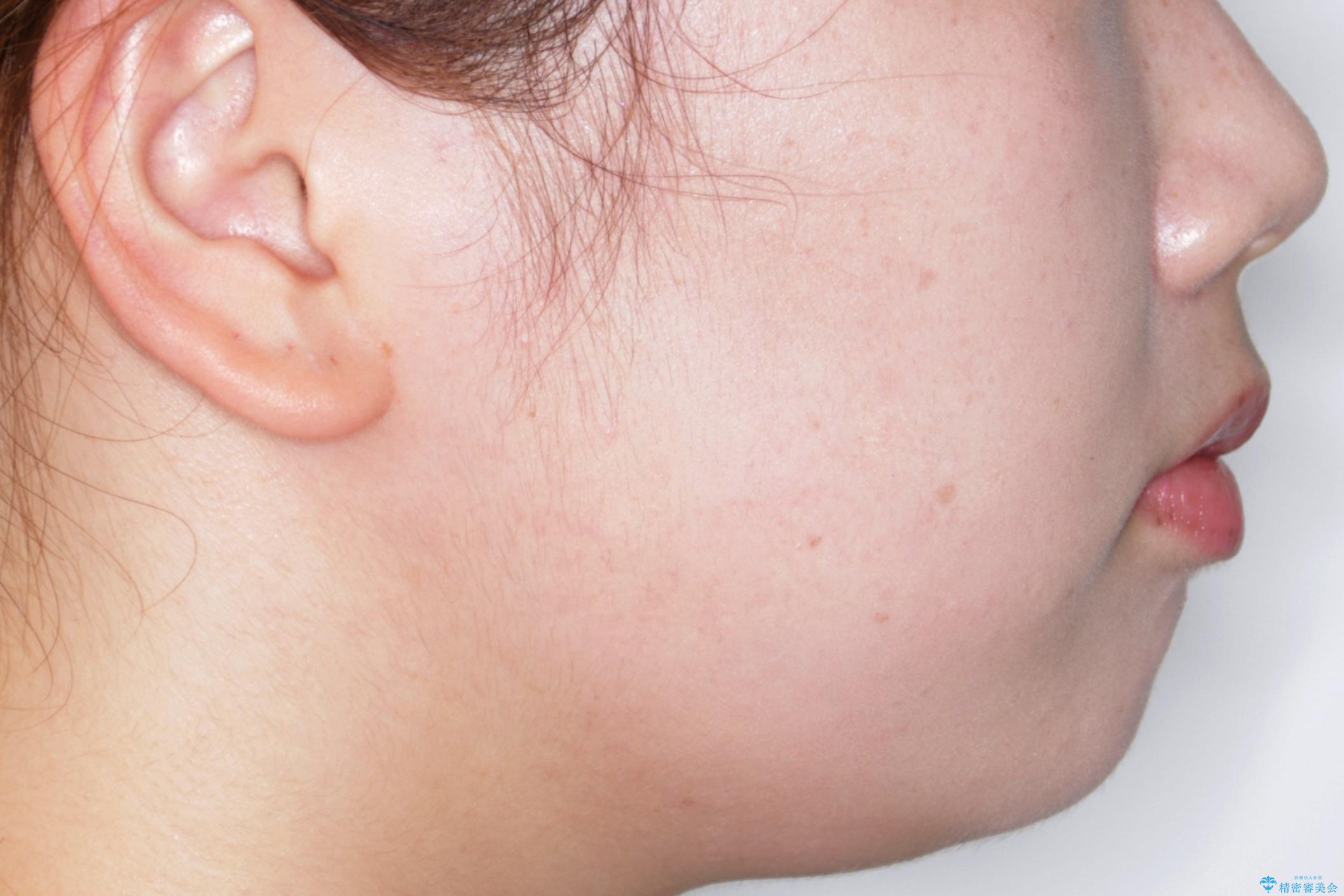 【抜歯】ハーフリンガル矯正で韓国美人な横顔へ!の治療前(顔貌)