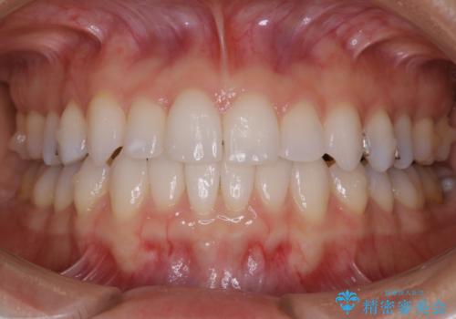 マウスピースの症例 治療後