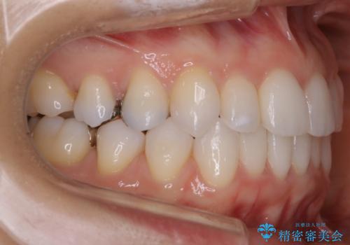 【非抜歯】マウスピースで短期間矯正の治療後