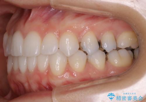 【非抜歯】マウスピースで短期間矯正の治療後