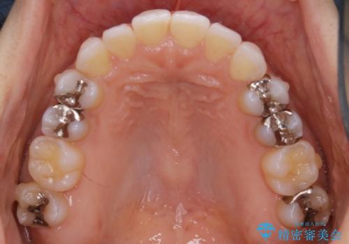 【非抜歯】マウスピースで短期間矯正の治療後