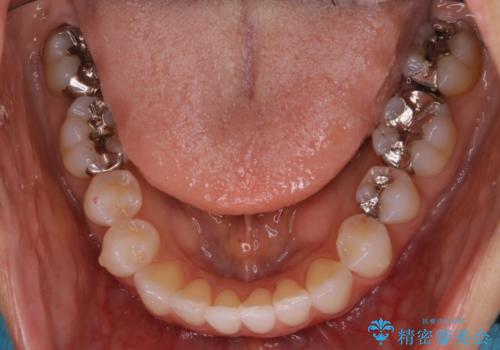 【非抜歯】マウスピースで短期間矯正の治療後