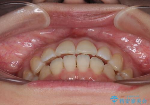 インビザライン・モデレートを用いて気になる後戻りを矯正治療の治療中