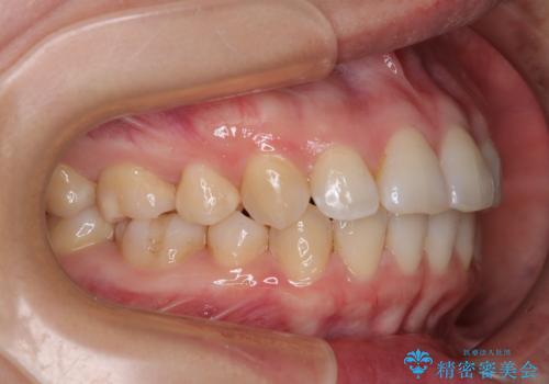 インビザライン・モデレートを用いて気になる後戻りを矯正治療の治療中