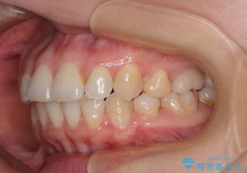 インビザライン・モデレートを用いて気になる後戻りを矯正治療の治療中
