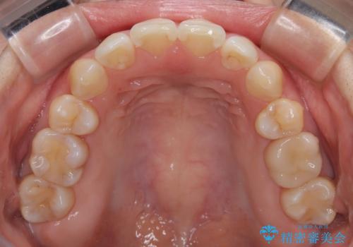 インビザライン・モデレートを用いて気になる後戻りを矯正治療の治療中