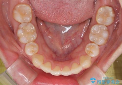 インビザライン・モデレートを用いて気になる後戻りを矯正治療の治療中