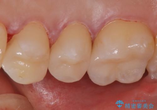 食べ物がよくはさまる セラミックインレーで清掃しやすい環境にの治療後