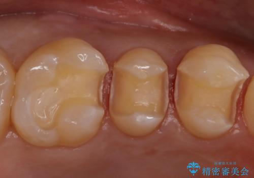 食べ物がよくはさまる セラミックインレーで清掃しやすい環境にの治療中