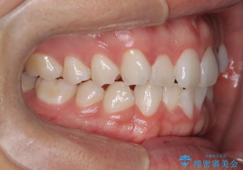 歯のデコボコを治したい|インビザラインで綺麗な歯並びに!|矯正期間は6ヵ月!の治療前