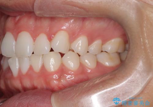 歯のデコボコを治したい|インビザラインで綺麗な歯並びに!|矯正期間は6ヵ月!の治療前