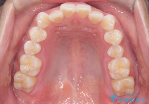 歯のデコボコを治したい|インビザラインで綺麗な歯並びに!|矯正期間は6ヵ月!の治療前