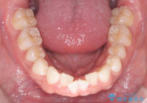 歯のデコボコを治したい|インビザラインで綺麗な歯並びに!|矯正期間は6ヵ月!の治療前