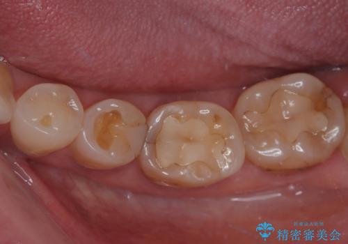 奥歯がたまにしみる フルジルコニアクラウンの補綴治療の症例 治療前