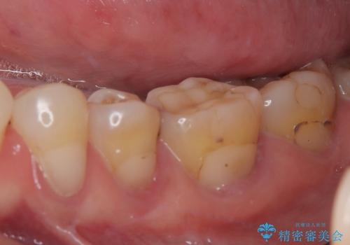 奥歯がたまにしみる フルジルコニアクラウンの補綴治療の治療前