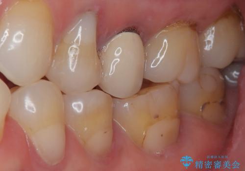 奥歯がたまにしみる フルジルコニアクラウンの補綴治療の治療前