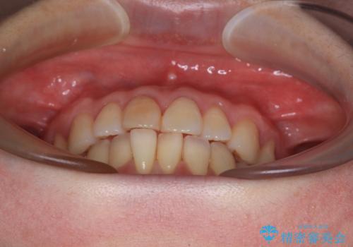 前歯のデコボコをインビザライン・モデレートで矯正治療の治療前