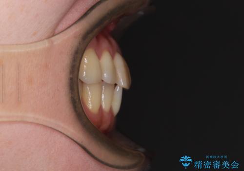 前歯のデコボコをインビザライン・モデレートで矯正治療の治療前