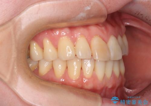 前歯のデコボコをインビザライン・モデレートで矯正治療の治療前