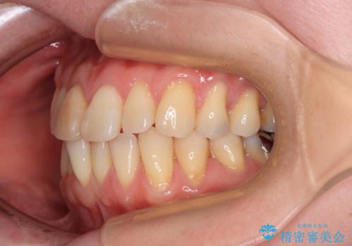 前歯のデコボコをインビザライン・モデレートで矯正治療の治療前