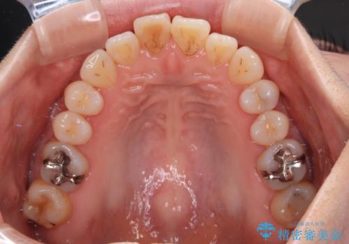 前歯のデコボコをインビザライン・モデレートで矯正治療の治療前