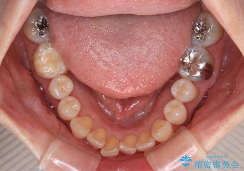 前歯のデコボコをインビザライン・モデレートで矯正治療の治療前