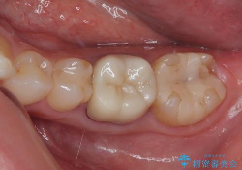 詰め物が欠けた フルジルコニアクラウンの症例 治療前