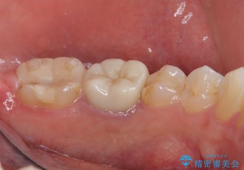詰め物が欠けた フルジルコニアクラウンの治療前