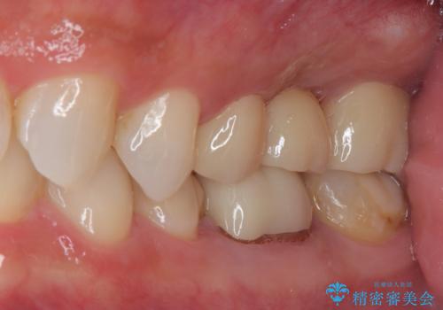詰め物が欠けた フルジルコニアクラウンの治療前