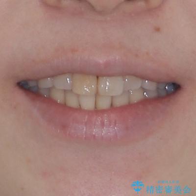前歯のデコボコをインビザライン・モデレートで矯正治療の治療前(顔貌)
