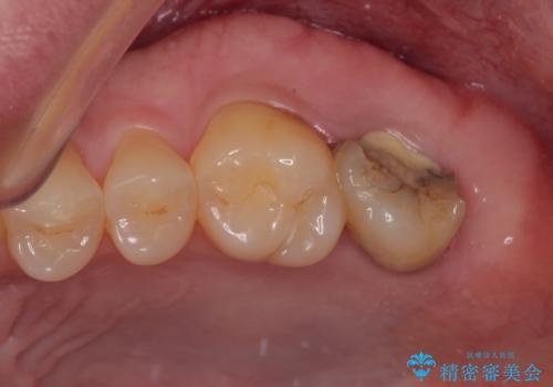 治療途中の虫歯の歯をインプラントにしたい インプラント治療の症例 治療前