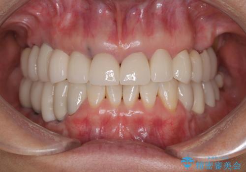 ニューヨークから1泊で通院 1DAYインプラントの治療後