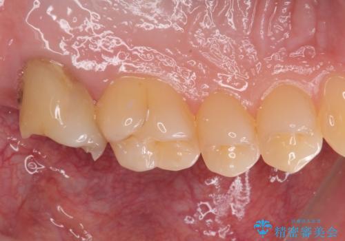 治療途中の虫歯の歯をインプラントにしたい インプラント治療の治療前