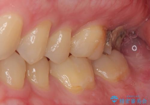 治療途中の虫歯の歯をインプラントにしたい インプラント治療の治療前