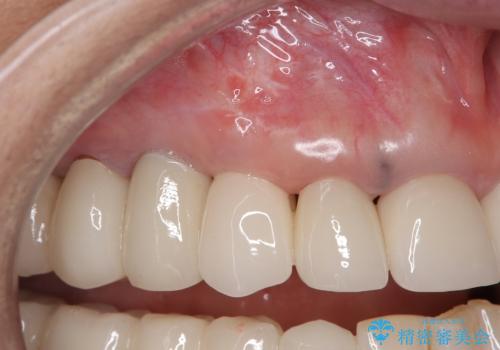 ニューヨークから1泊で通院 1DAYインプラントの治療後