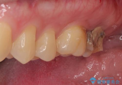 治療途中の虫歯の歯をインプラントにしたい インプラント治療の治療前