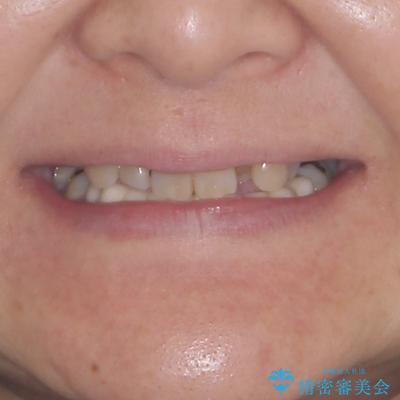外れるブリッジと気になる八重歯 総合歯科治療で美しい口元にの治療前(顔貌)