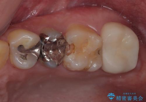 プラスチックの詰め物が外れた オールセラミッククラウンの症例 治療前