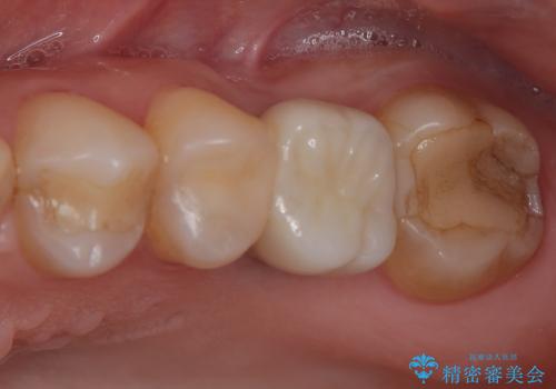 割れてしまった奥歯 インプラント治療の症例 治療後