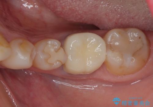 割れてしまった奥歯 インプラント治療の治療後