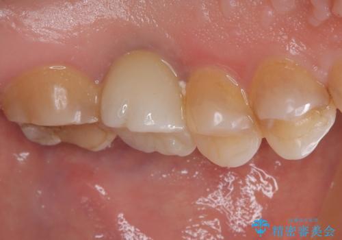 割れてしまった奥歯 インプラント治療の治療後