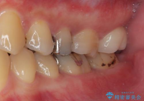 プラスチックの詰め物が外れた オールセラミッククラウンの治療前