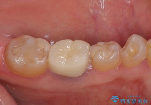 割れてしまった奥歯 インプラント治療の治療後