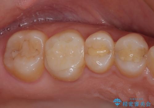 割れてしまった奥歯 インプラント治療の治療後