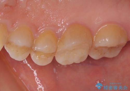 割れてしまった奥歯 インプラント治療の治療後