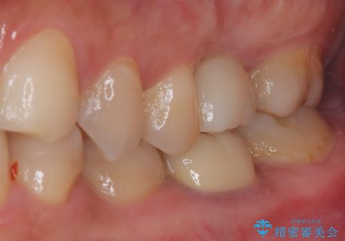 割れてしまった奥歯 インプラント治療の治療後