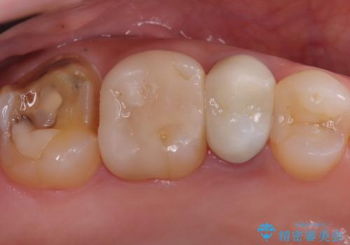 詰め物が欠けた 〈セラミッククラウン〉の症例 治療前