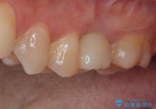割れてしまった奥歯 インプラント治療の治療後