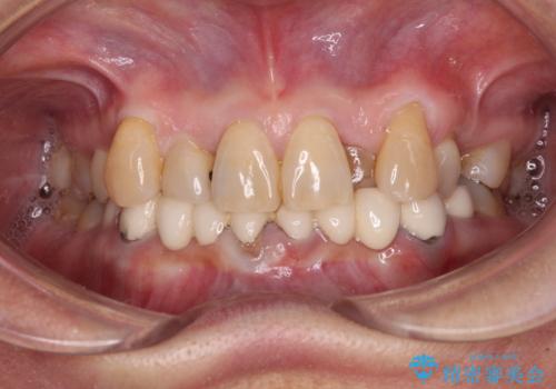 外れるブリッジと気になる八重歯 総合歯科治療で美しい口元にの症例 治療前