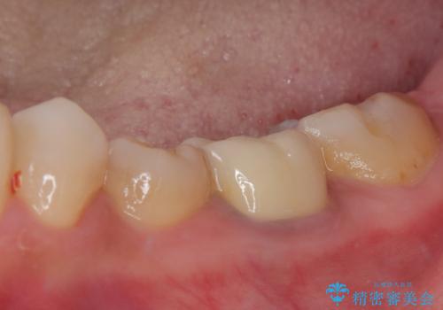 割れてしまった奥歯 インプラント治療の治療後